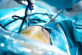Understanding Knee Surgery: What You Need to Know